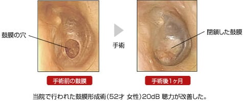 鼓膜形成術 公式 細田耳鼻科ear Clinic 大阪府豊中市 土曜診察可