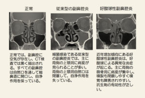 副鼻腔炎