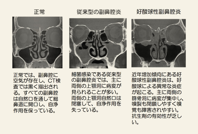 好 酸 球 性 副 鼻腔 炎 治っ た ブログ