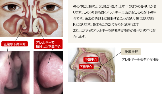 粘膜 焼く 鼻