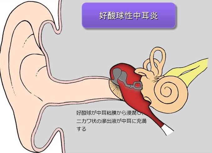 図解で見る、好酸球性中耳炎