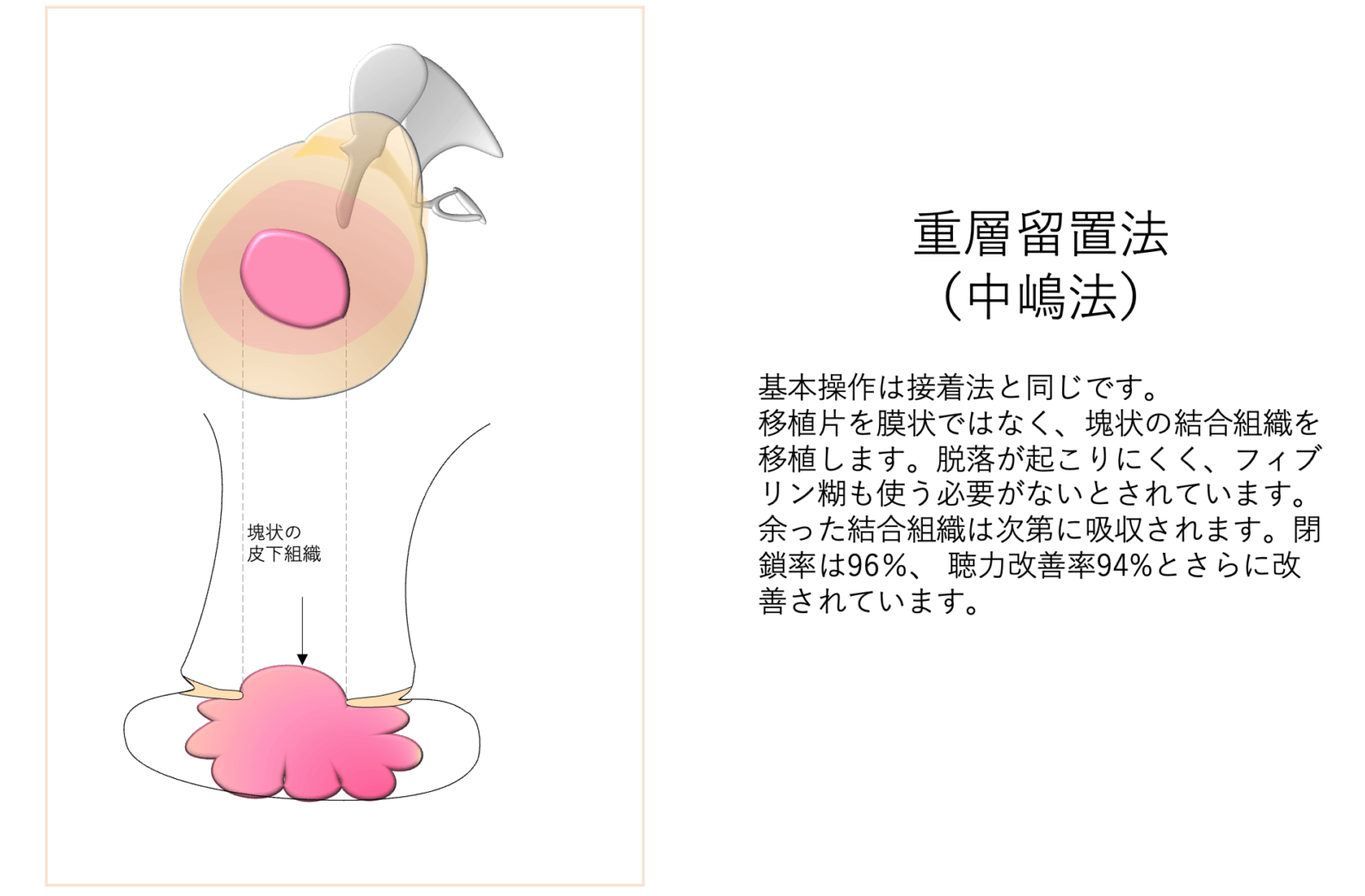 重層留置法