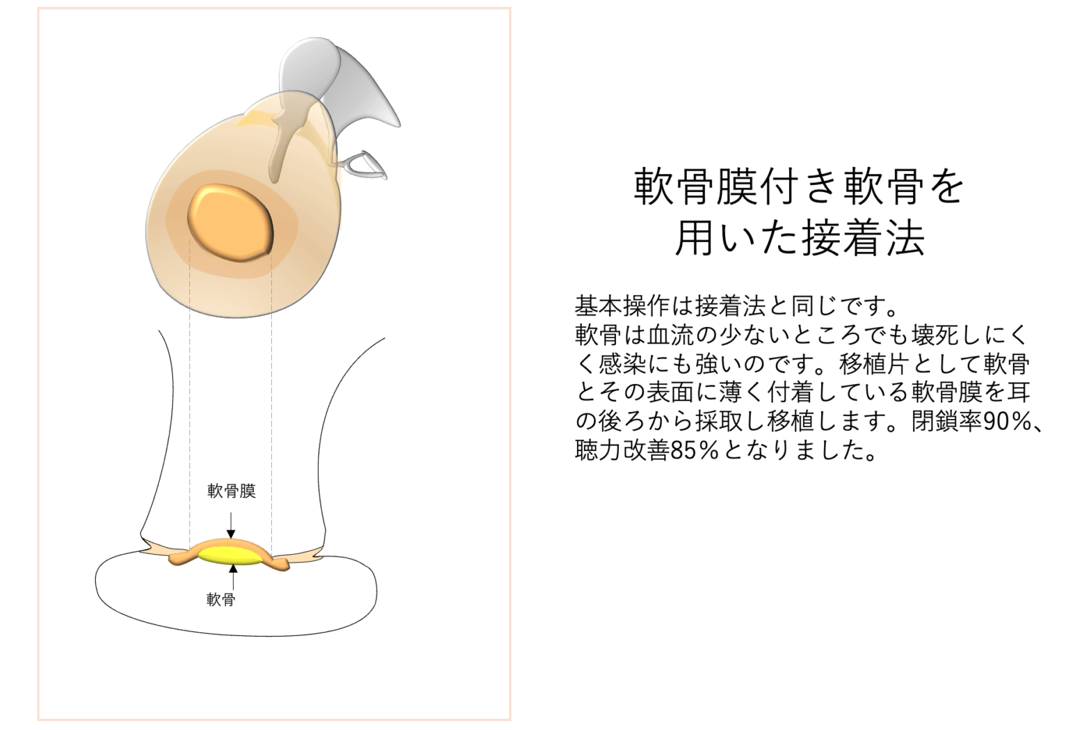 軟骨膜付き軟骨を用いた接着法