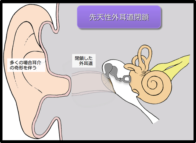 図解で見る先天性外耳道閉鎖