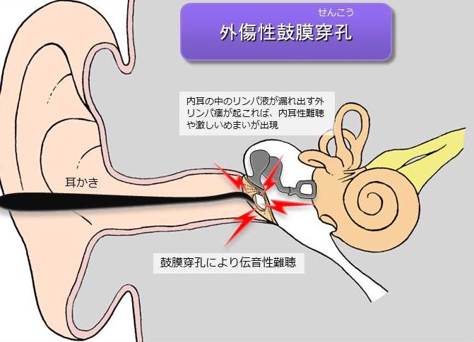 外傷性鼓膜穿孔の原因と治療法について 大阪府豊中市細田耳鼻科