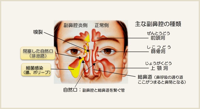 蓄膿症 顔 の 腫れ