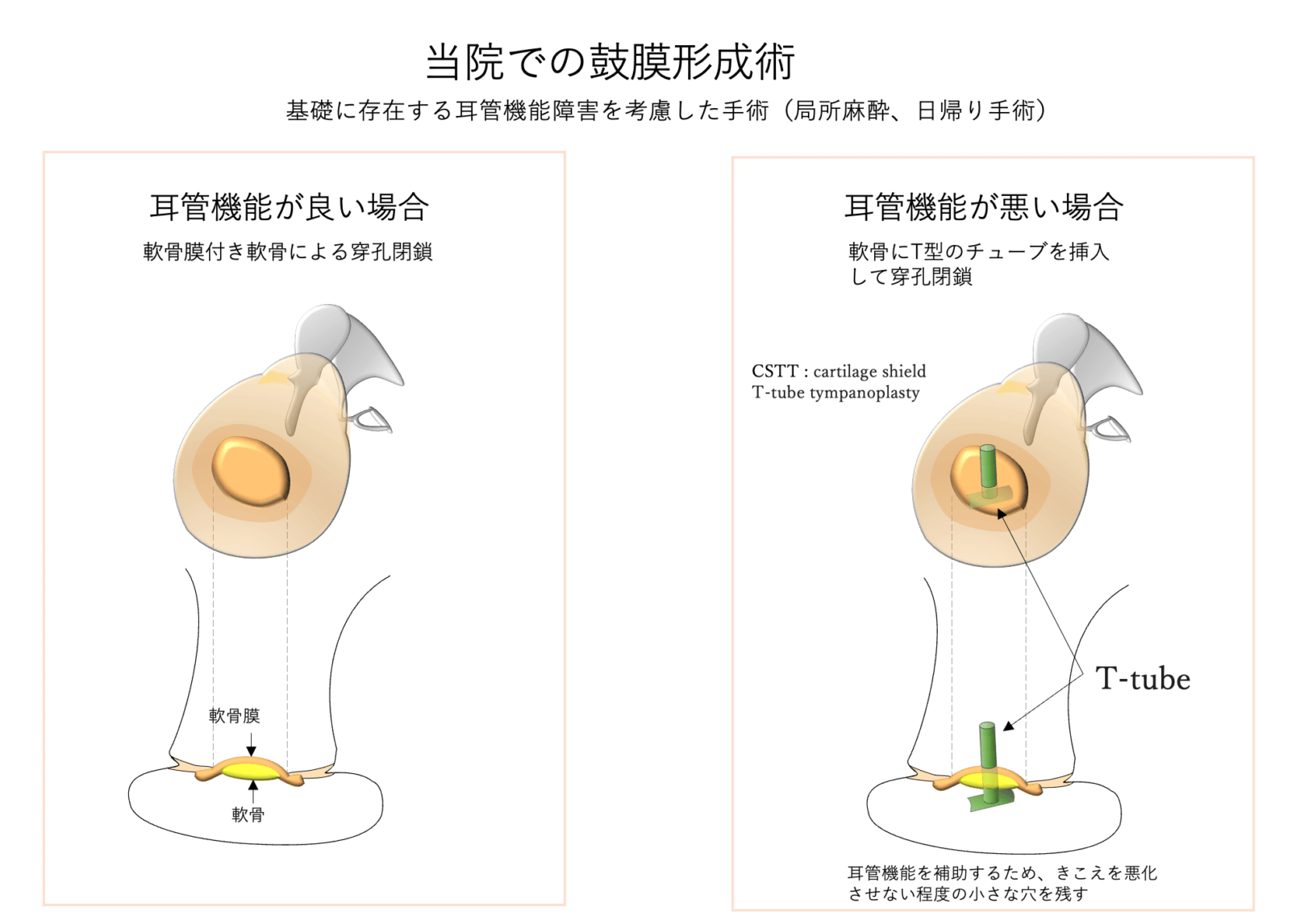 当院での鼓膜形成術