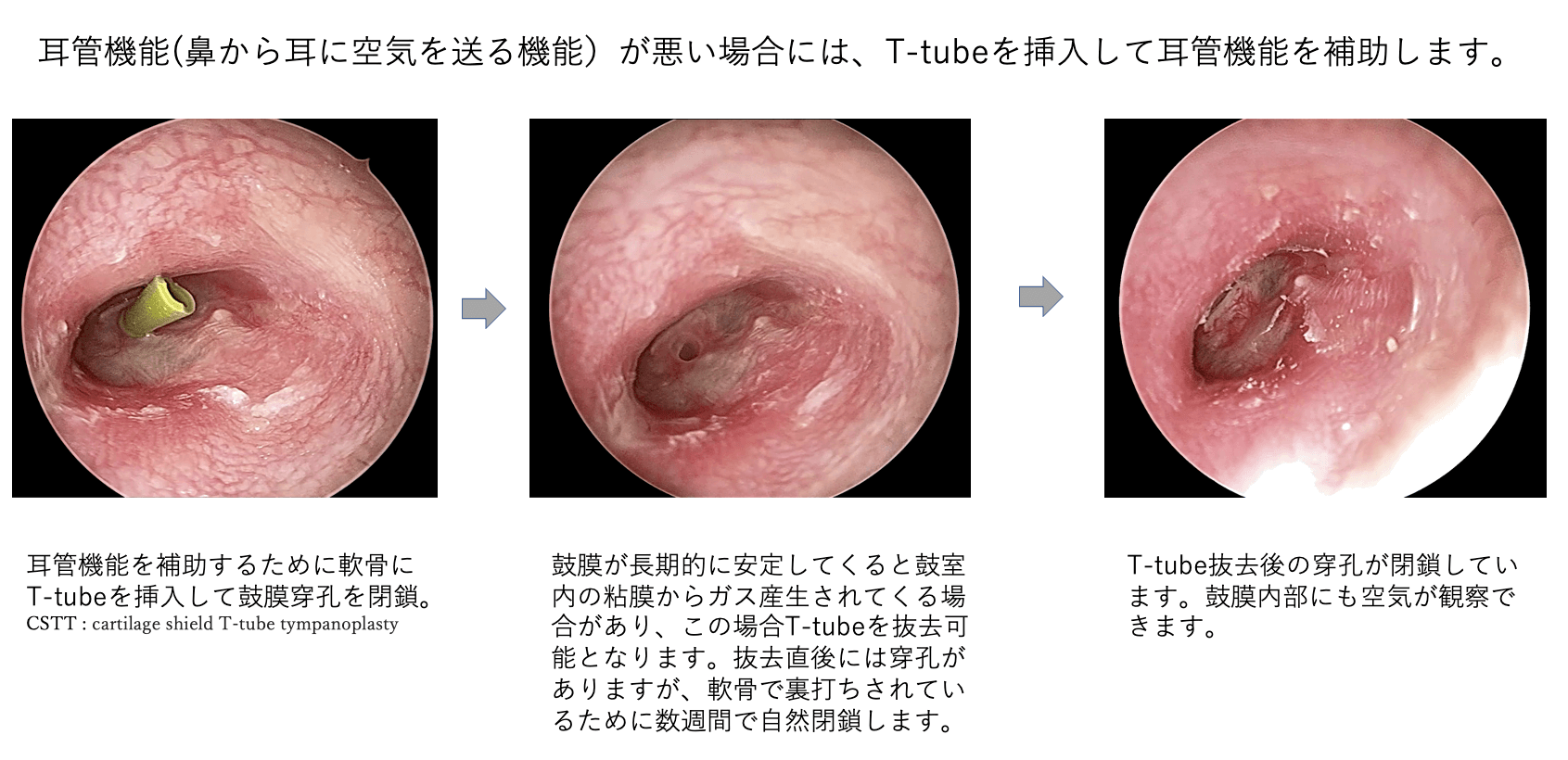 耳管機能が割る場合には、T-tubeを挿入して耳管機能を補助します。