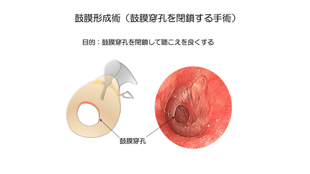 鼓膜再生療法 手術手技マニュアル 鼓膜再生療法 手術手技マニュアル | 金丸眞一, 金井理絵 |本